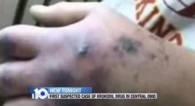 '좀비 마약'/방송 화면 캡처