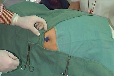 Aspiration needle placement.