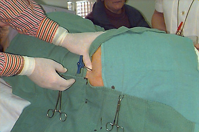 Bone marrow biopsy. Jamshidi needle placement.