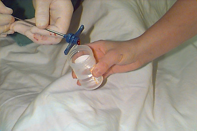 Bone marrow biopsy specimen.