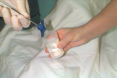 Bone marrow biopsy specimen.