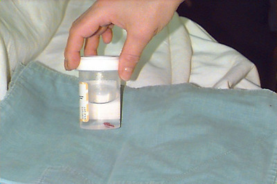 Bone marrow biopsy specimen in fixative solution.