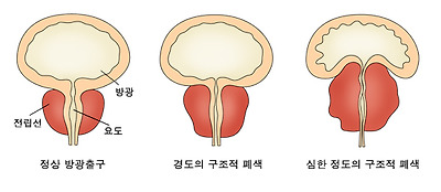 방광경 검사