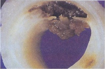 불안정한 경화반 파열로 혈전이 형성된 동맥