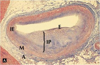 죽상경화가 발생한 혈관의 단면도
