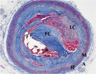 죽상경화가 발생한 혈관의 단면도