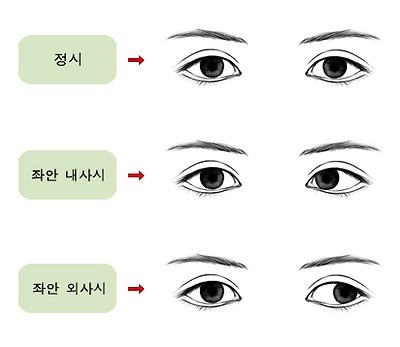 정상, 내사시, 외사시