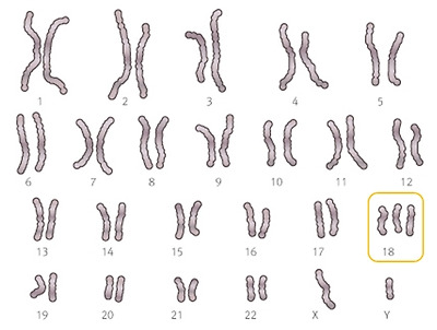염색체 검사 사진: 18번 염색체가 3개 있음