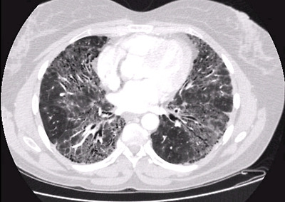 미만성 간질성 폐질환 확인을 위한 x-ray사진