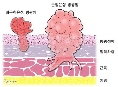 진행 단계에 따른 방광암의 분류  - 비근침윤성 방광암, 근침윤성 방광암,  방광점막, 점막하층, 근육, 지방