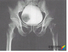 방광암의 배설요로조영술 소견