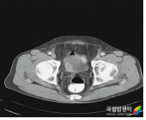근침윤성 방광암의 전산화단층촬영 사진