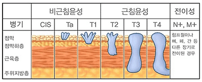 방광암의 진행단계 - 병기, 점박, 점막하층, 근육층, 주위지방층, 비근침윤성(CIS, Ta, T1), 근침윤성(T2, T3, T4), 전이성(N+, M+) 림프절이나 뼈, 폐, 간 등 다른 장기로 전이된 경우