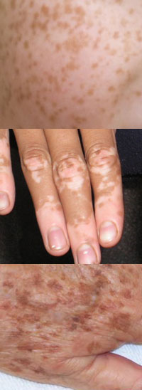 Skin pigmentation Skin pigmentation