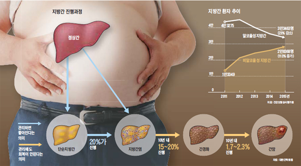 지방간 진행과정 그래픽