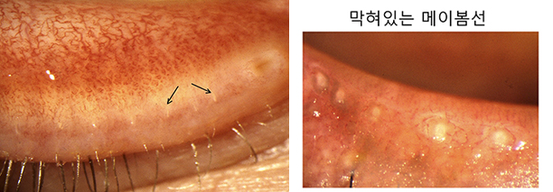 눈꺼풀 기름샘 위치, 굳은 기름으로 막힌 기름샘 모습