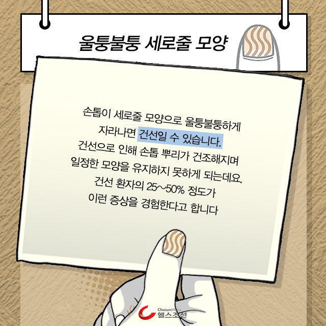 세로줄 손톱 이미지