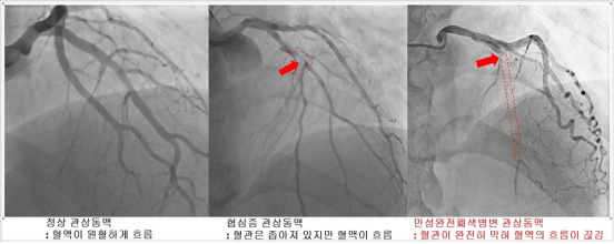 관상동맥 조영술 사진