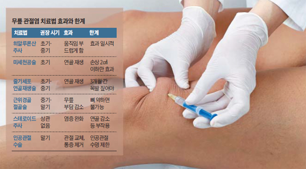 무릎 관절염의 근본적인 치료는 인공관절수술이다. 하지만 말기 관절염에만 인공관절 수술을 적용하므로, 그 전 단계에서도 통증이 있다면 히알루론산 주사, 줄기세포 수술 등 다양한 치료법을 선택할 수 있다.