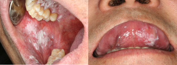 볼 안쪽 점막에 나타난 백색 반점(왼쪽)과 혀 아래 나타난 백색 반점과 적색 반점