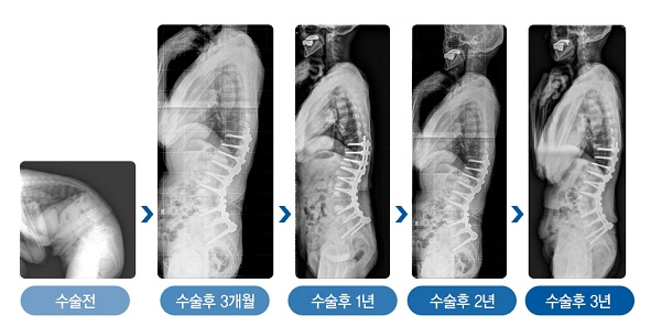 심한 노인성 후만변형으로 수술을 받은 78세 환자의 수술 3년간 변화 사진