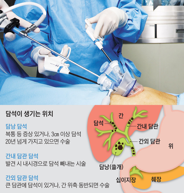 담낭 담석이 있는 사람이 복통 등의 증상이 있으면 담낭을 떼는 수술을 해야 한다.