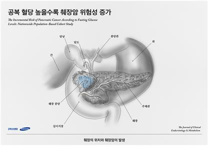 췌장암 위치