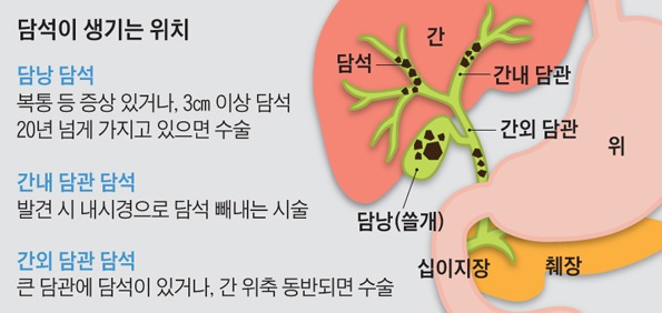 담석증 관련 그림