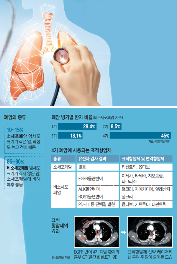 폐암 병기별 환자 비율 그래픽