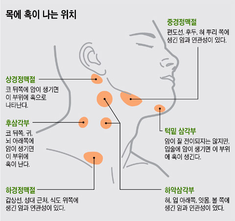 목에 혹이 나는 위치 그래픽