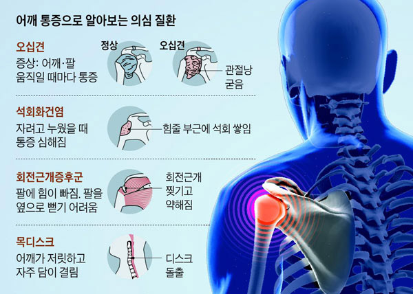 어깨 통증으로 알아보는 의심질환 그림 설명