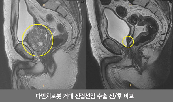 전립선암 수술 전후 사진