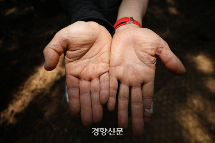 김동수(55)씨 손과 팔에 남은 상처의 흔적들. 왼손 한가운데는 유리병이 관통한 흉터다. / 권도현 기자