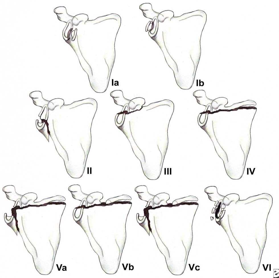Classification of glenoid cavity fractures: IA - ...