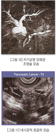 자기공명 담췌관 조영술, 내시경적 초음파 모습