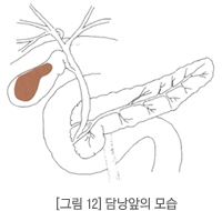 담낭암의 모습