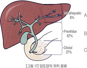 담도암의 위치 분류