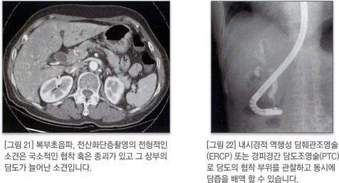 담도암 진단