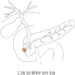 팽대부 암의 모습