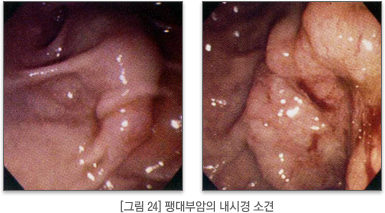 팽대부암의 내시경 소견