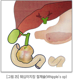 췌십이지장 절제술 (Whipple’s op)