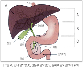 간내 담도암, 간문부 담도암, 윈위부 담도암의 위치