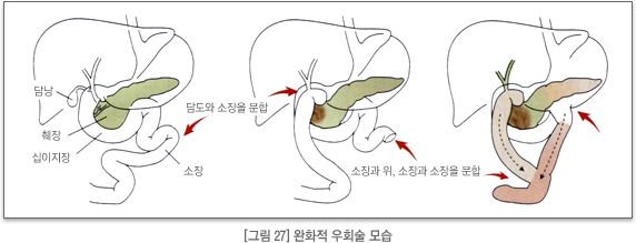 완화적 우회술 모습