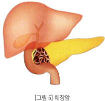 췌장암