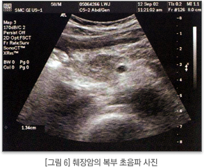 췌장암의 복부 초음파 사진