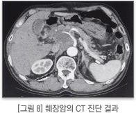 췌장암의 CT 진단 결과