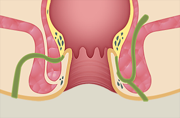 항문에 대한 이미지 검색결과