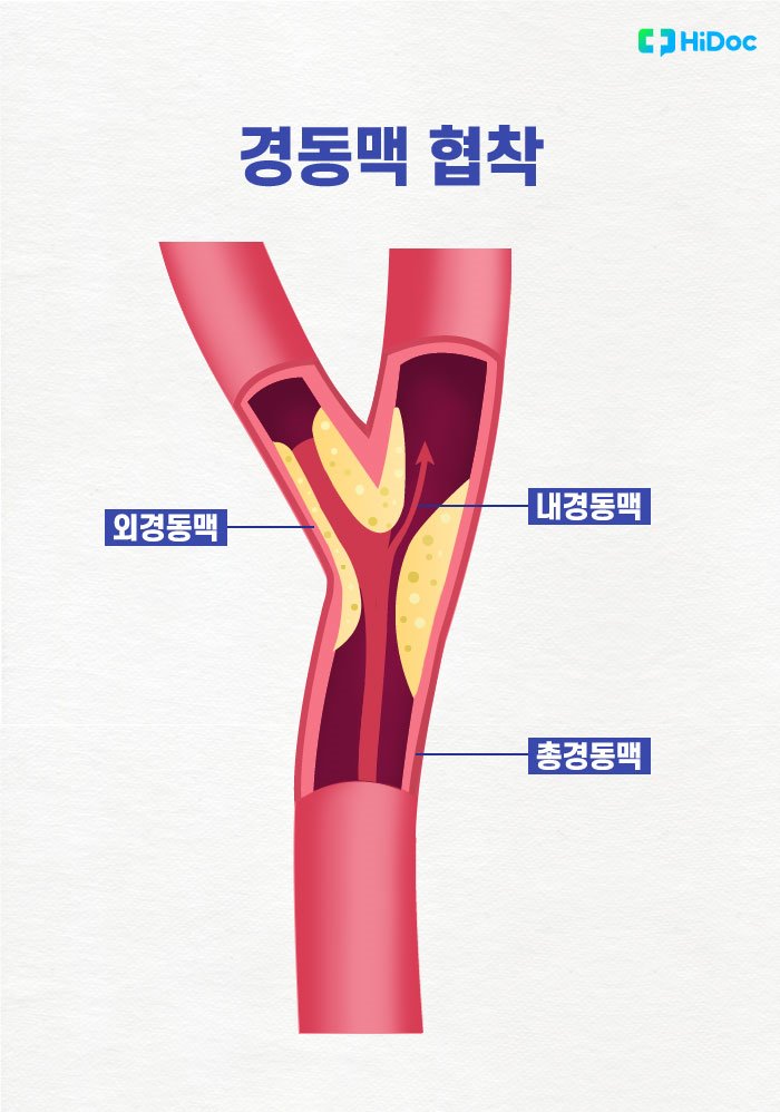 경동맥 협착증