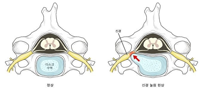신경 눌림 현상