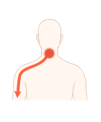 경추신경근병증 방사통